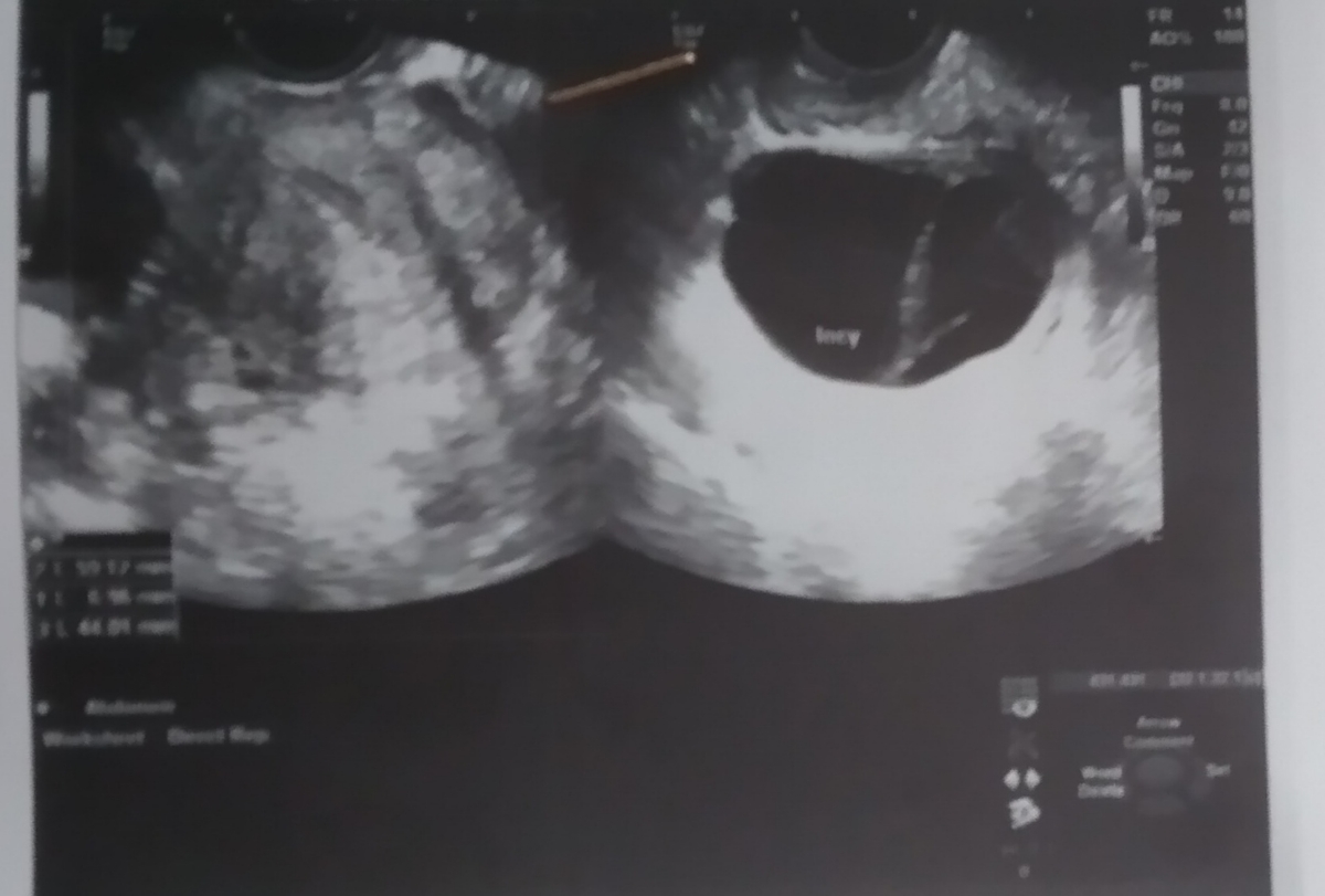 تفسیر سونو واژینال رحم و تخمدان تفسیر سونو واژینال رحم و تخمدان