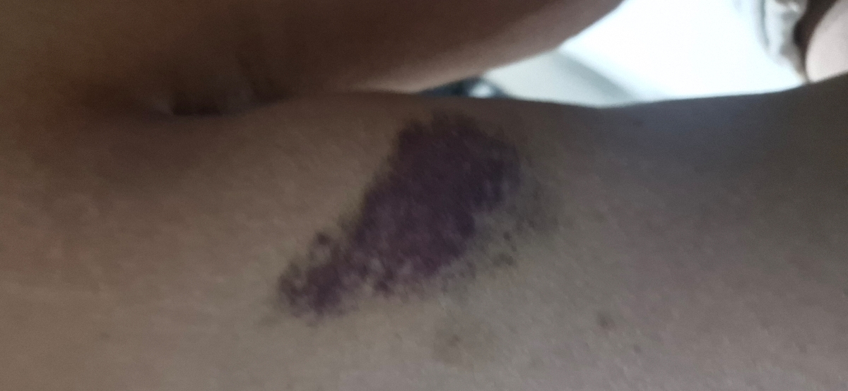 کبودی جای امپول آنوکسا روی بازو