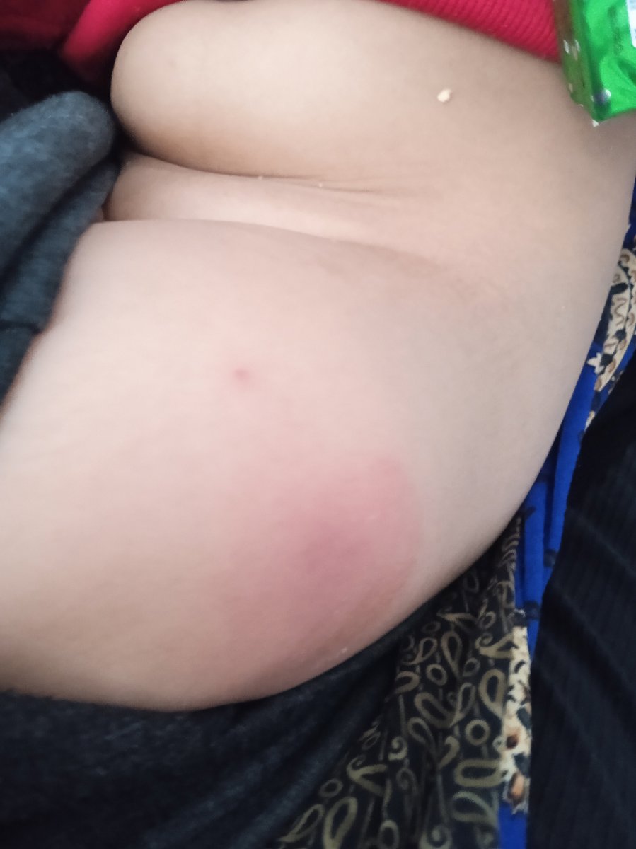 واکسن 18ماهگی ورم جای واکسن
