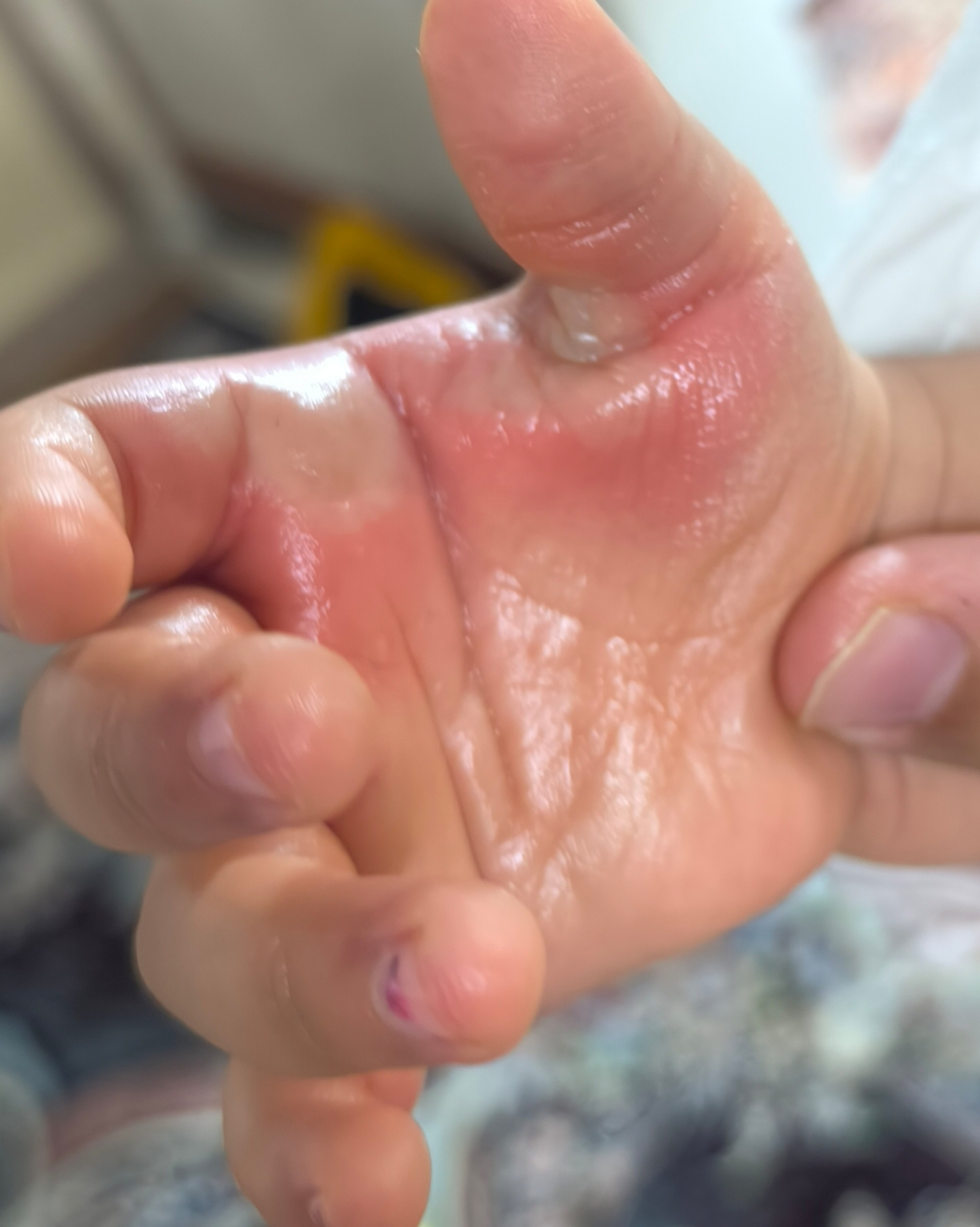 سوختگی دست پسرم با اگزوز موتور سوختگی دست پسرم با اگزوز موتور