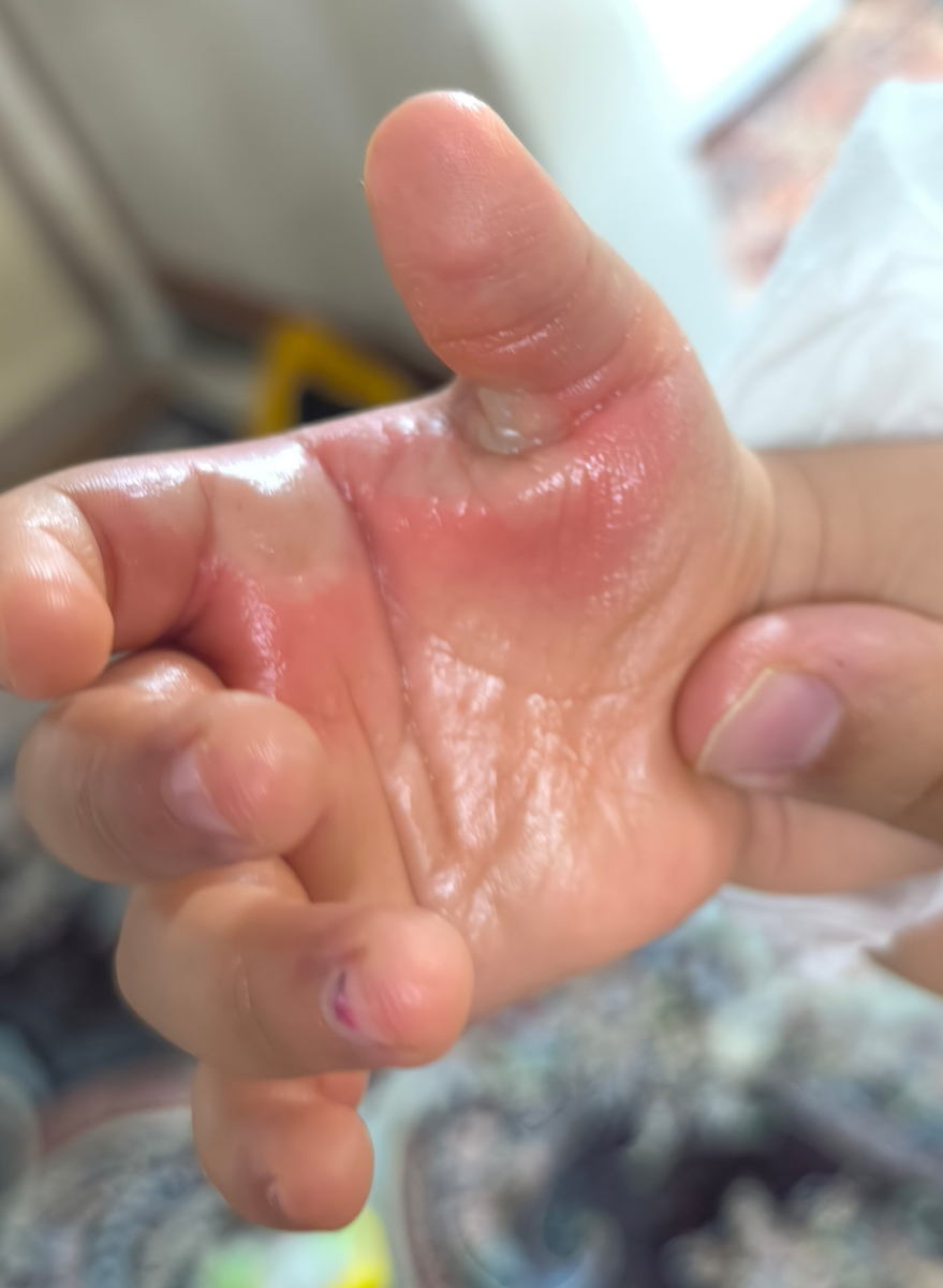 سوختگی دست پسرم با اگزوز موتور سوختگی دست پسرم با اگزوز موتور