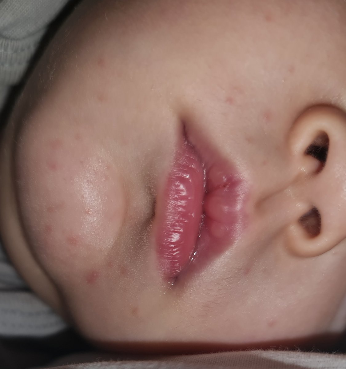 جوش های اطراف دهان نوزاد یکساله جوش های اطراف دهان نوزاد یکساله