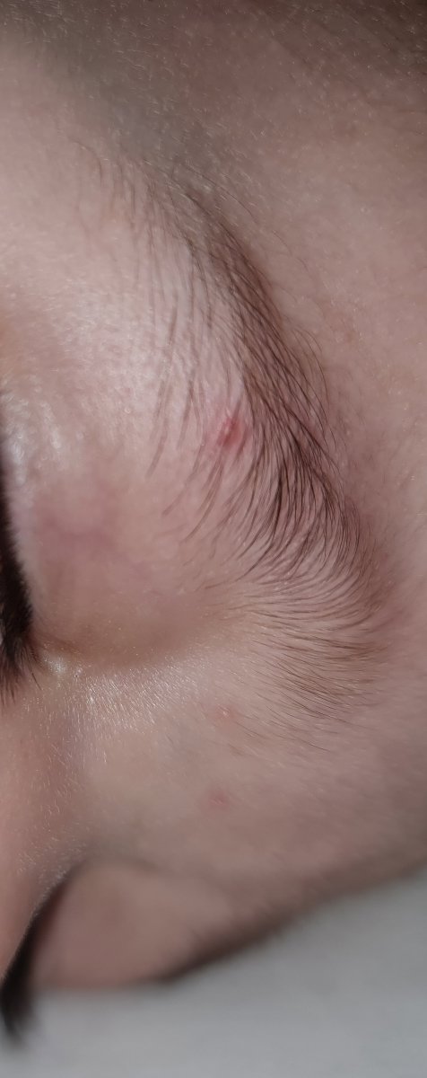 جوش های اطراف دهان نوزاد یکساله جوش های اطراف دهان نوزاد یکساله