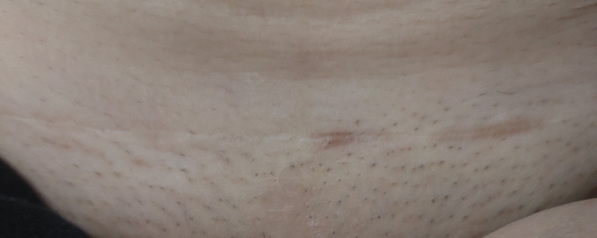 اینم جای بخیه. ببین اصلا مشخص نیست اینم جای بخیه. ببین اصلا مشخص نیست