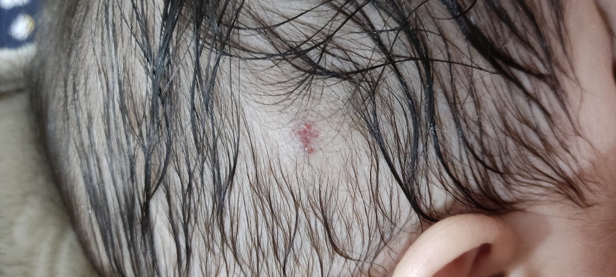 خال عروقی در نوزادن