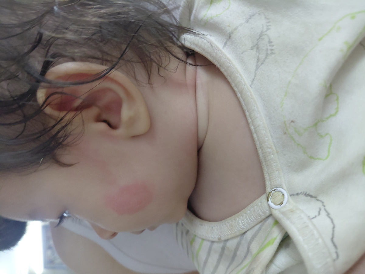 قرمزی صورت نوزاد همراه با خارش قرمزی صورت نوزاد همراه با خارش