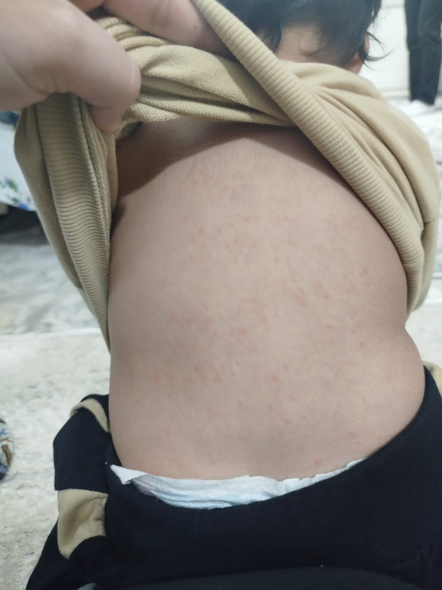 عفونت گوش و دونه های قرمز