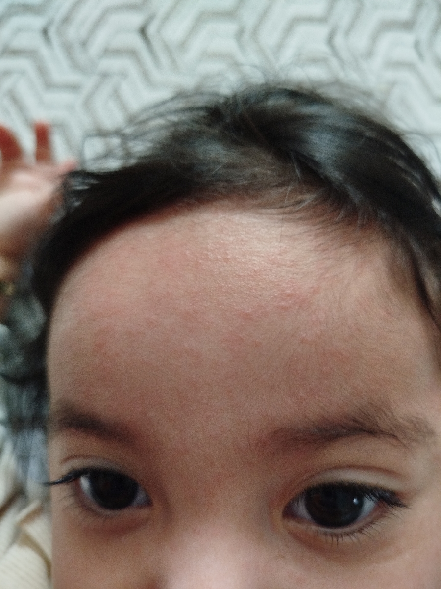 عفونت گوش و دونه های قرمز