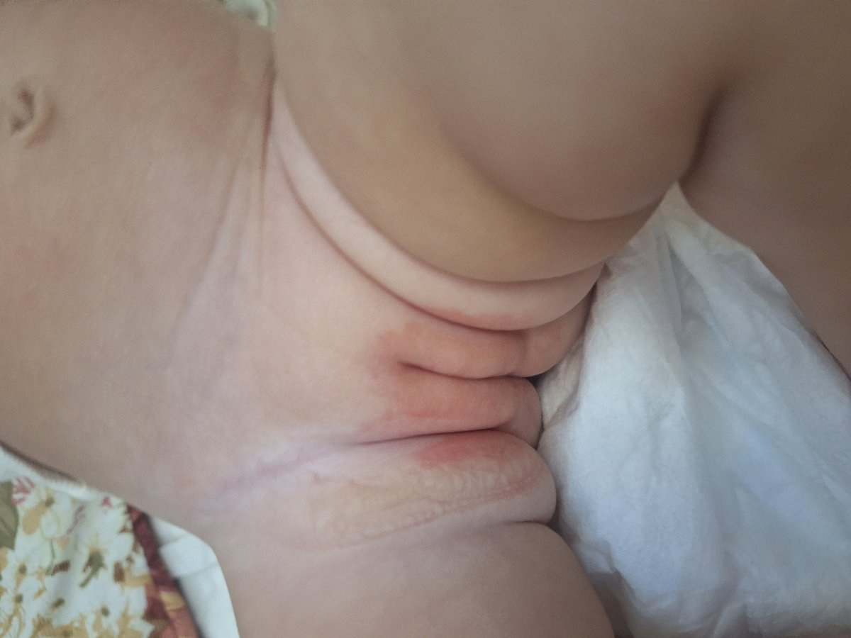 سلام خانم دکتر، بابت سوختگی ناحیه خصوصی پیام میدم سلام خانم دکتر، بابت سوختگی ناحیه خصوصی پیام میدم