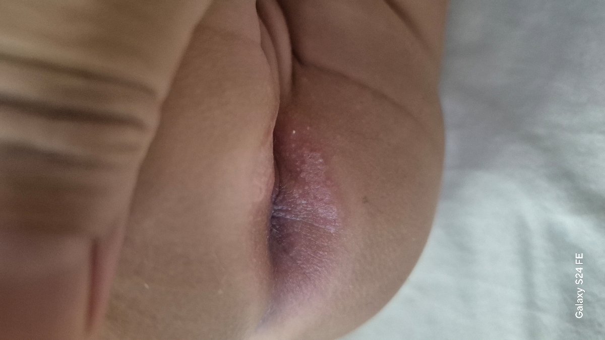 سوختگی محل دفع نوزاد