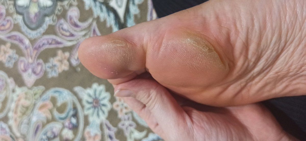 پینه یاخشکی پا سرشدن شصت پا