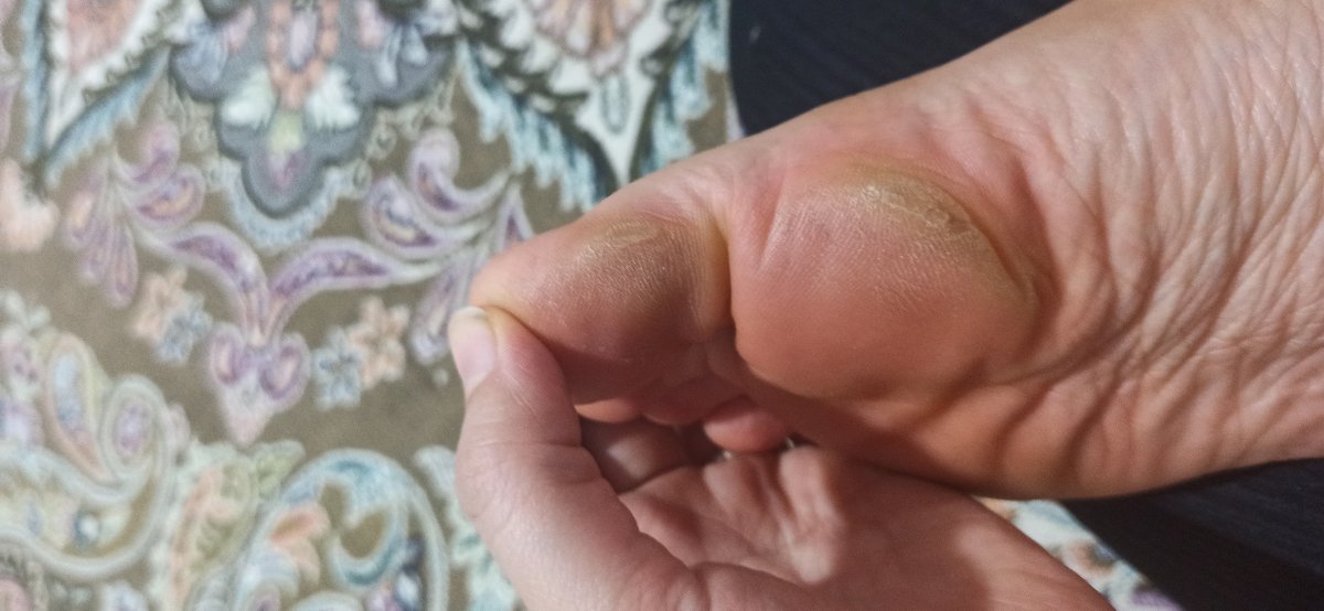 پینه یاخشکی پا سرشدن شصت پا