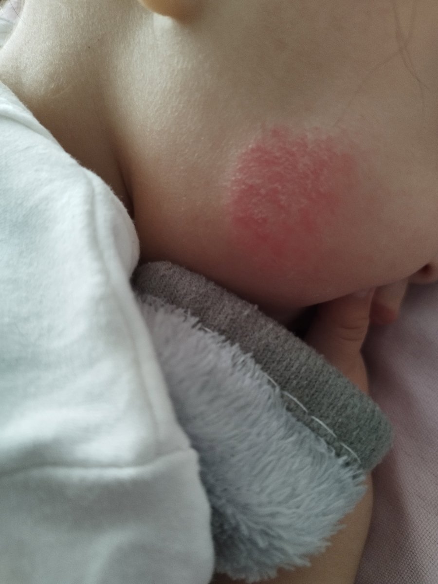 حساسیت صورت ۶ ماهه حساسیت صورت ۶ ماهه
