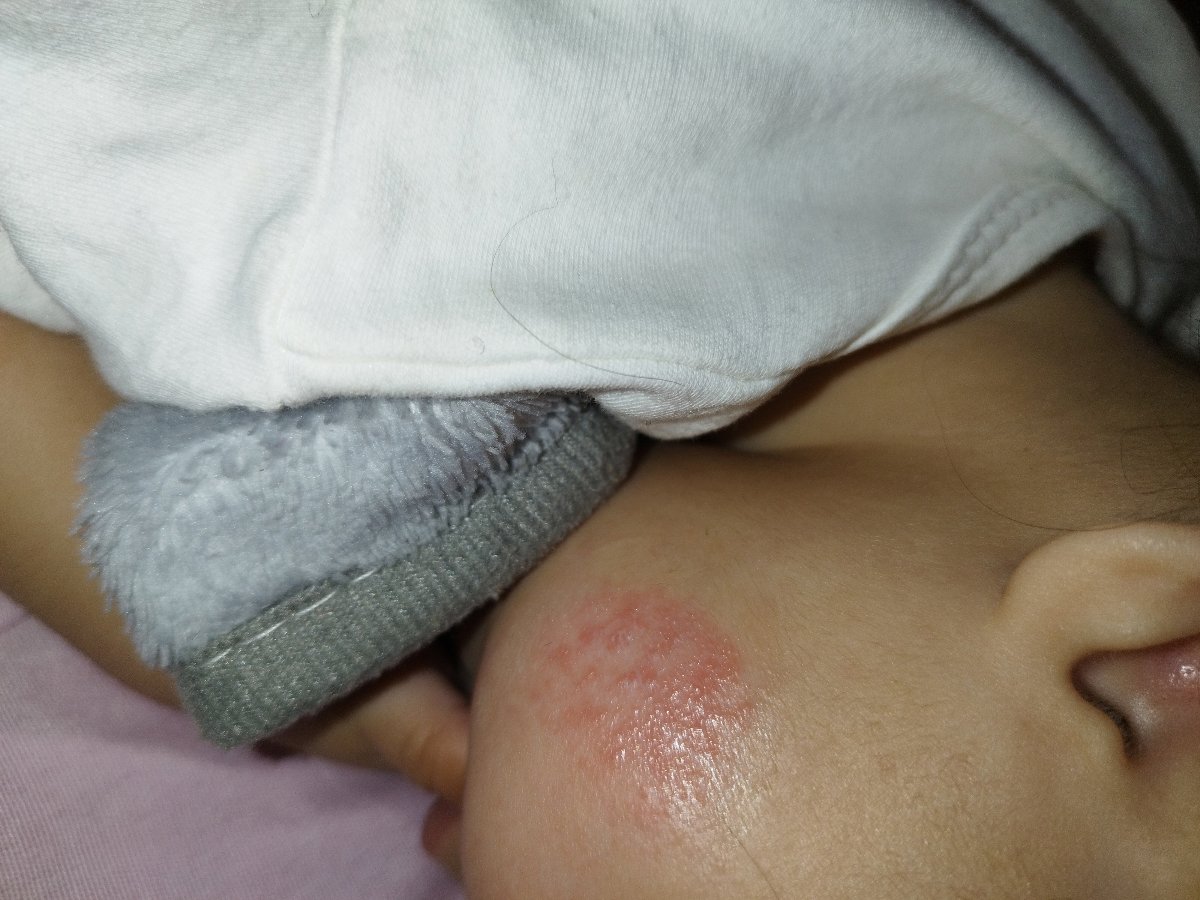 حساسیت صورت ۶ ماهه حساسیت صورت ۶ ماهه