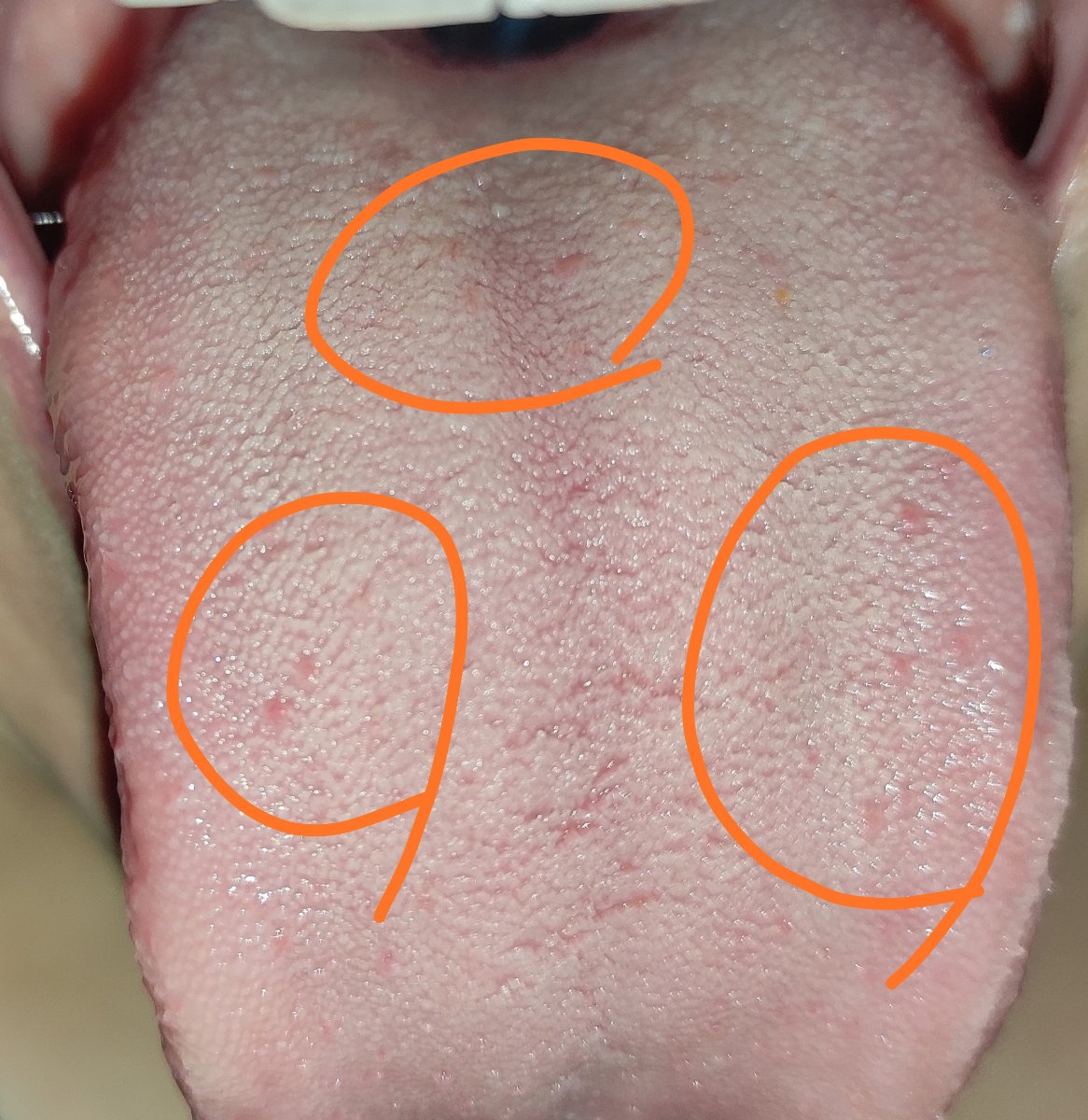 دونه های اطراف گلو زگیل هستن؟ دونه های اطراف گلو زگیل هستن؟