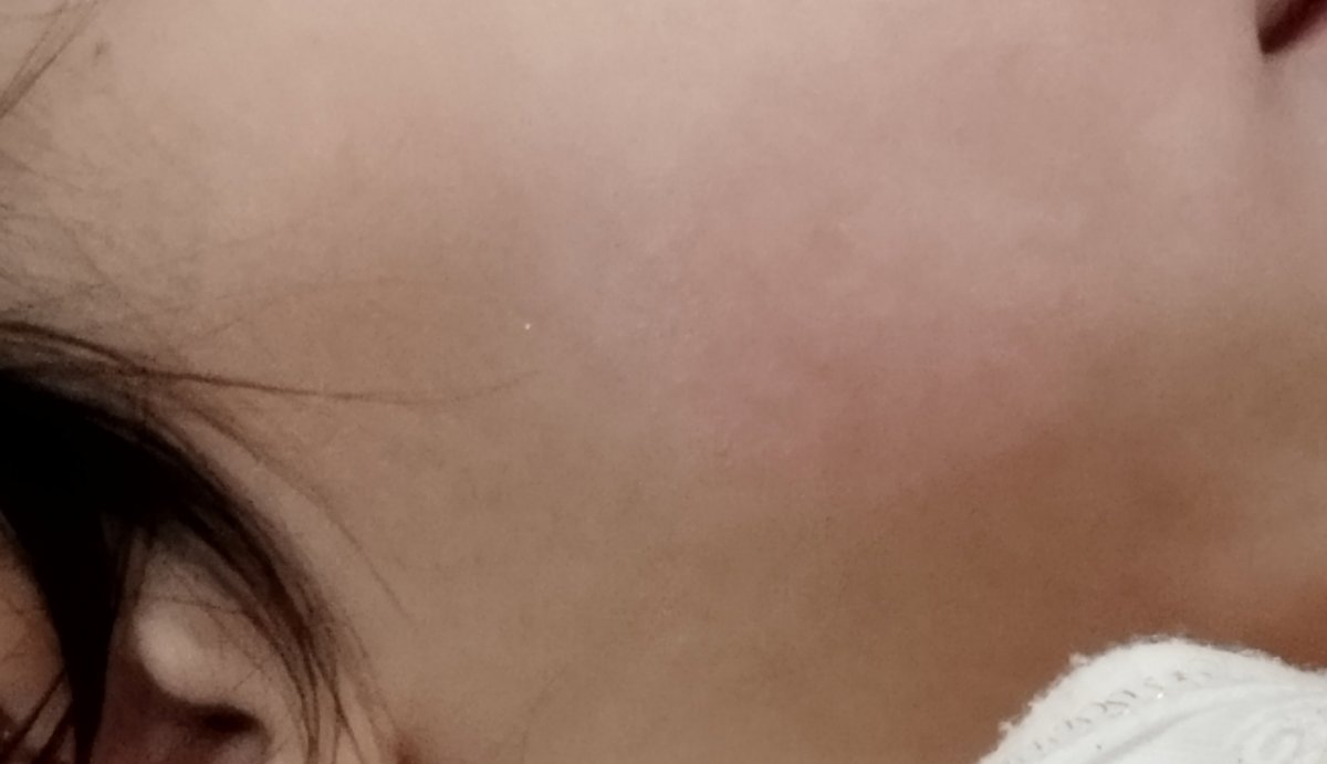 حساسیت صورت ۶ ماهه حساسیت صورت ۶ ماهه