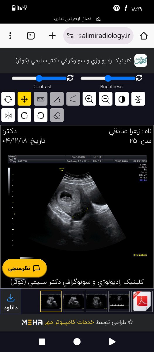 سایز ساک بارداری بارداری سایز ساک بارداری بارداری