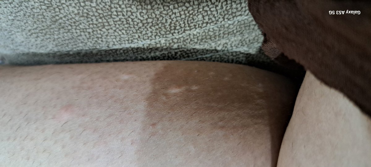 خارش بدن دارم میتونه عوارض داروهایی که میخورم باشه؟؟؟ خارش بدن دارم میتونه عوارض داروهایی که میخورم باشه؟؟؟