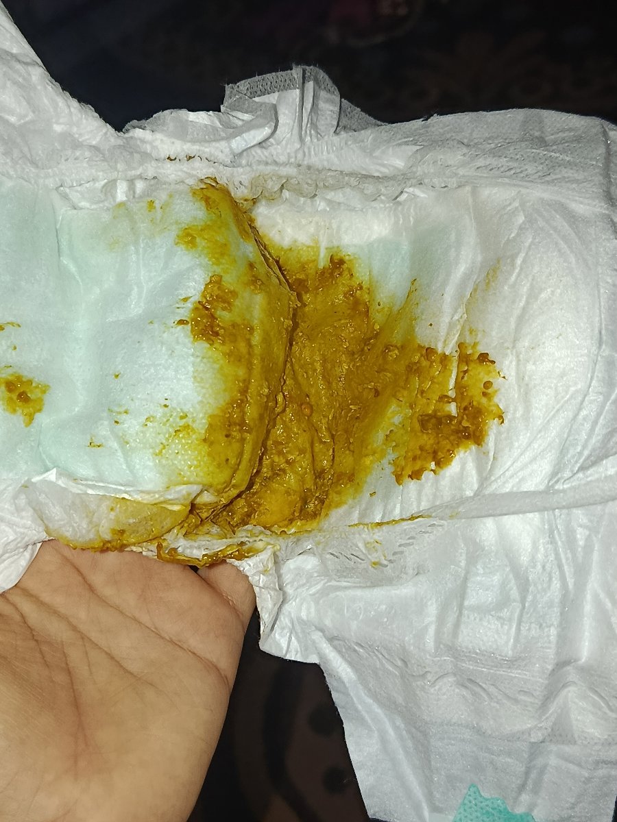 مدفوع نوزاد یک ماه و ۲۲روزه حاوی عکس میباشد هرکس نمیتونه نگاه نکنه🌺 مدفوع نوزاد یک ماه و ۲۲روزه حاوی عکس میباشد هرکس نمیتونه نگاه نکنه🌺