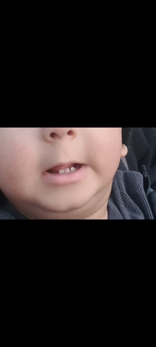 دندان نوزاد ۱۱ماهه در نیومده