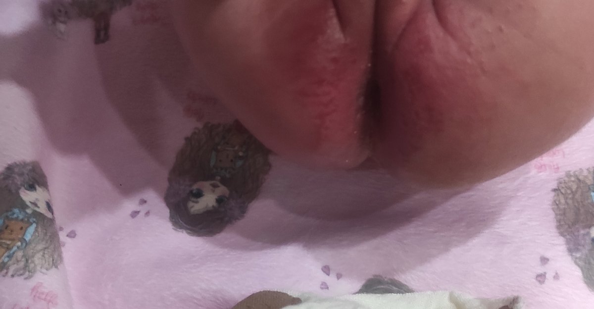 سوختگی محل دفع نوزاد سوختگی محل دفع نوزاد