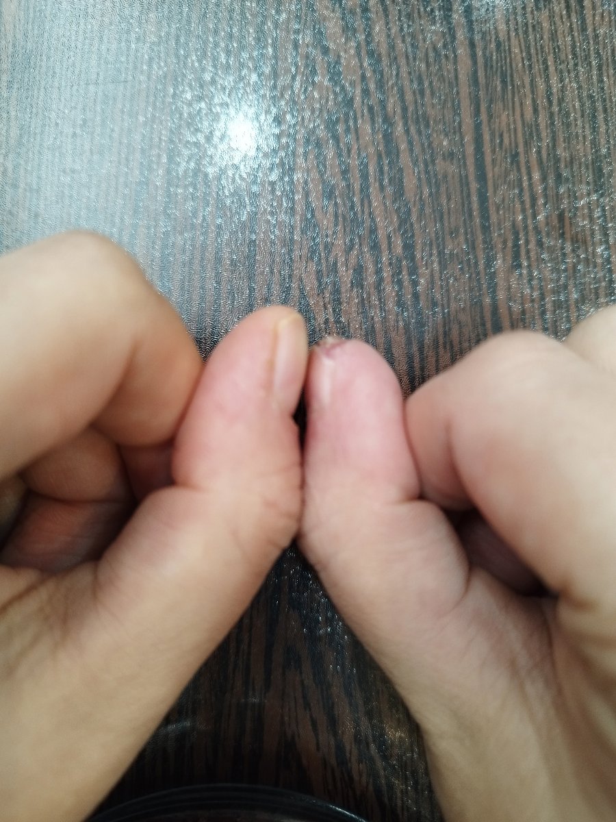 اینجا خوب شدم 😍🤣🤣 یه کمی بالاش زخم از جراحی مونده بود
کوتاه شده یه کم انگشتام
هم چپی و هم راستی
راستی بیشتر از چپی