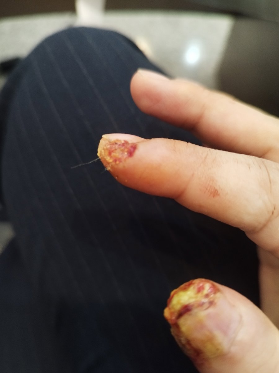 انگشت اشاره م ۳ جلسه ای خوب شد 
