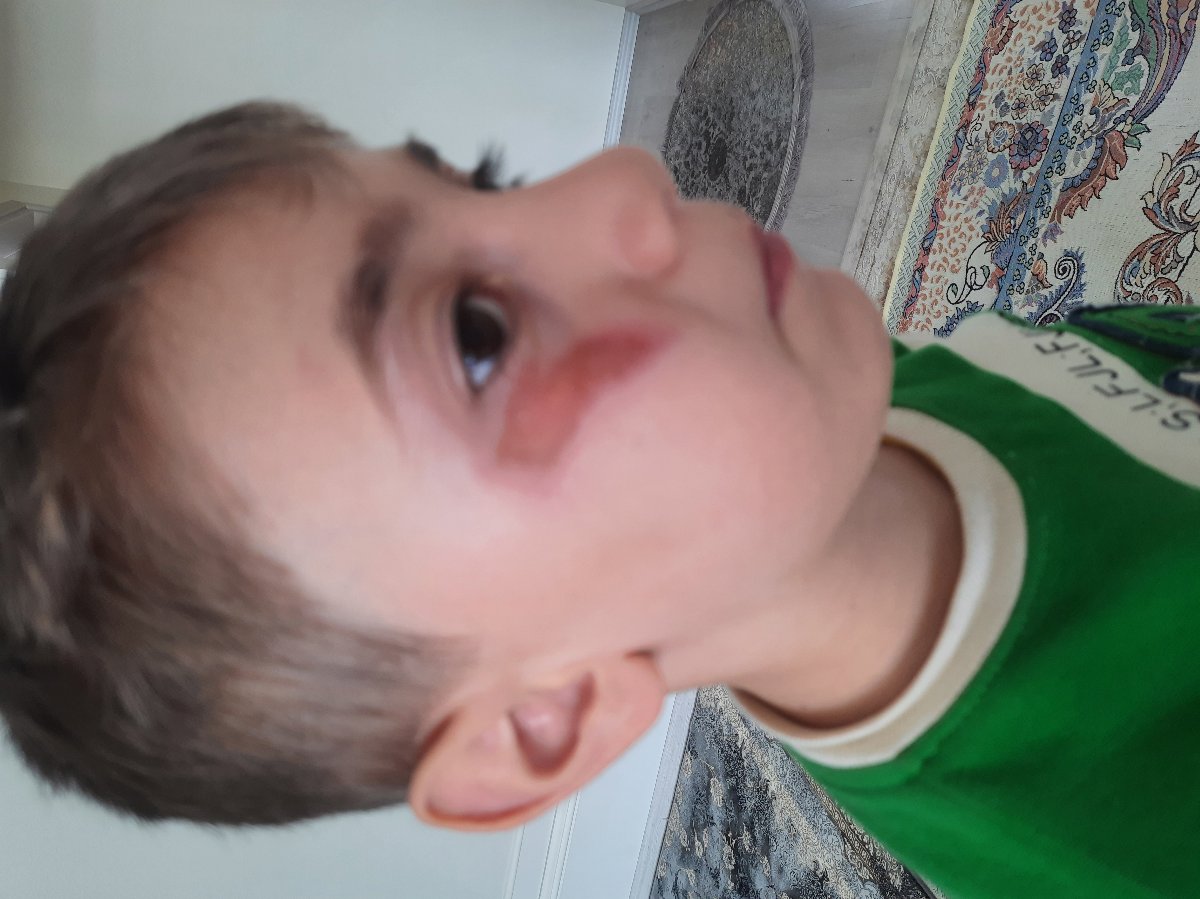 برای ساییدگی پوست صورت چی بزنم؟ برای ساییدگی پوست صورت چی بزنم؟