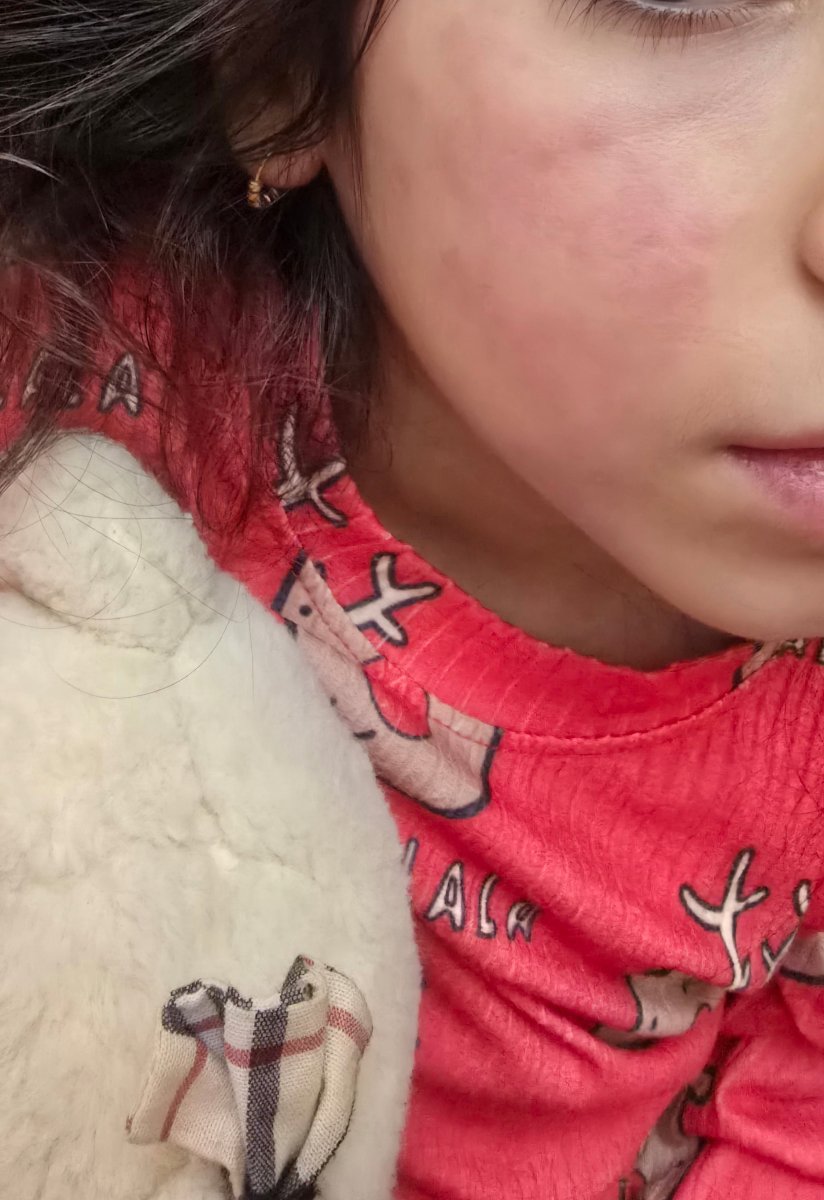 کهیر روی صورت و بدن دخترم کهیر روی صورت و بدن دخترم