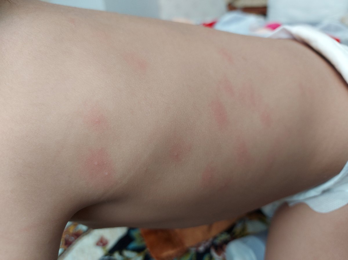 حساسیت به تخم مرغ یا پرتقال حساسیت به تخم مرغ یا پرتقال