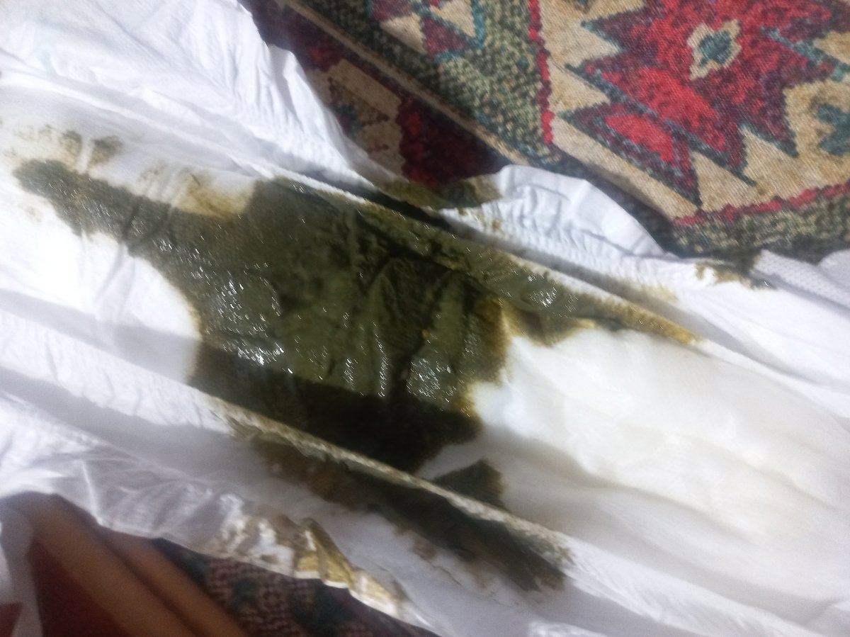 مدفوع سبز نوزاد ۲ ماهه همراه عکس مدفوع سبز نوزاد ۲ ماهه همراه عکس