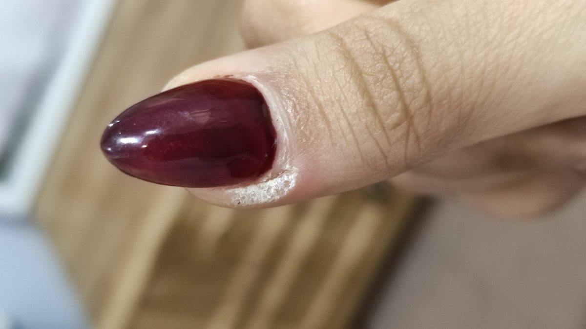 زگیل کنار ناخن انگشت دست