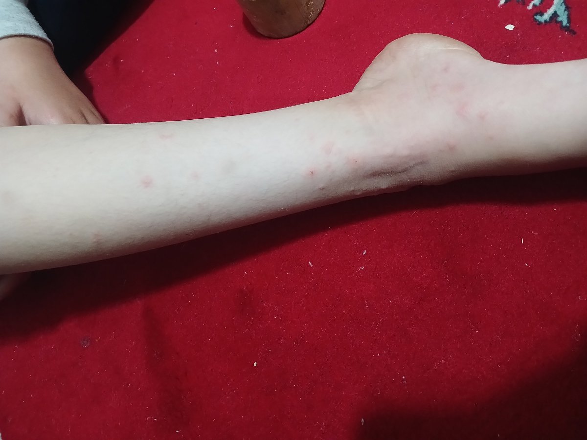 این دونه ها آبله مرغون هستش این دونه ها آبله مرغون هستش
