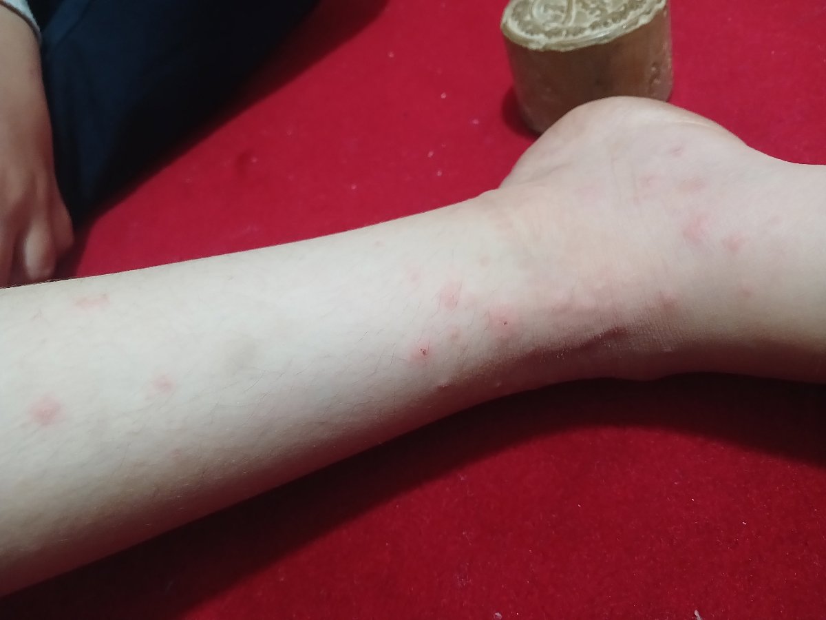 این دونه ها آبله مرغون هستش این دونه ها آبله مرغون هستش