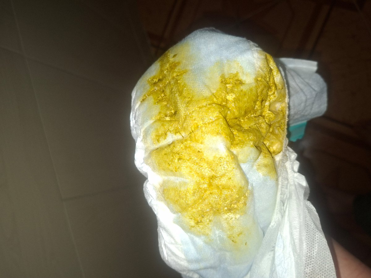 حساسیت به پروتئین گاوی📛❌️(حاوی عکس مدفوع)❌️📛 حساسیت به پروتئین گاوی📛❌️(حاوی عکس مدفوع)❌️📛