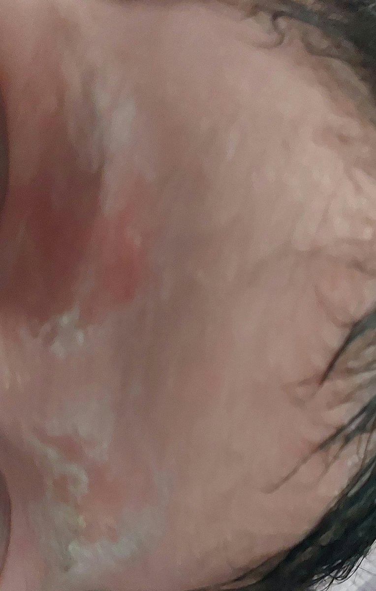 خشکی صورت و قرمزی زیرگلو خشکی صورت و قرمزی زیرگلو