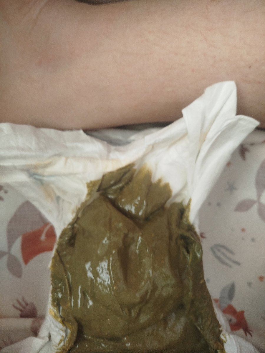 حساسیت به پروتئین گاوی حاوی عکس حساسیت به پروتئین گاوی حاوی عکس