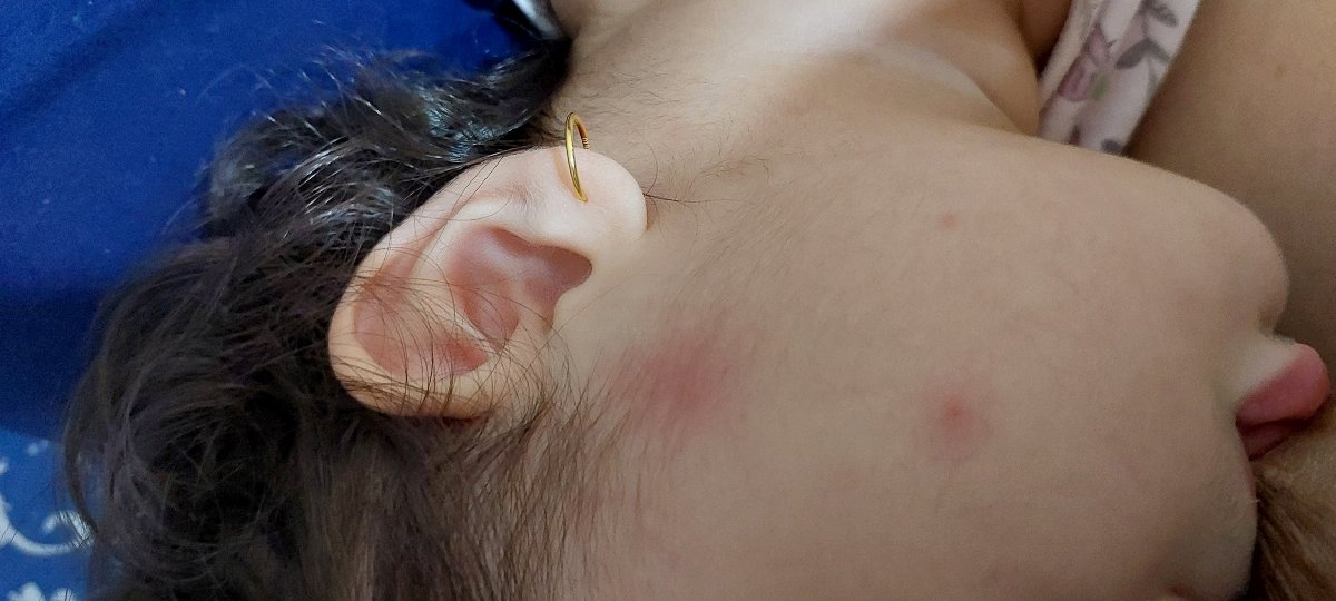 واکسن یکسالگی و علائم سرخک واکسن یکسالگی و علائم سرخک