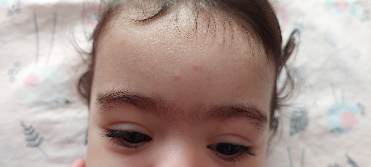 واکسن یکسالگی و علائم سرخک واکسن یکسالگی و علائم سرخک