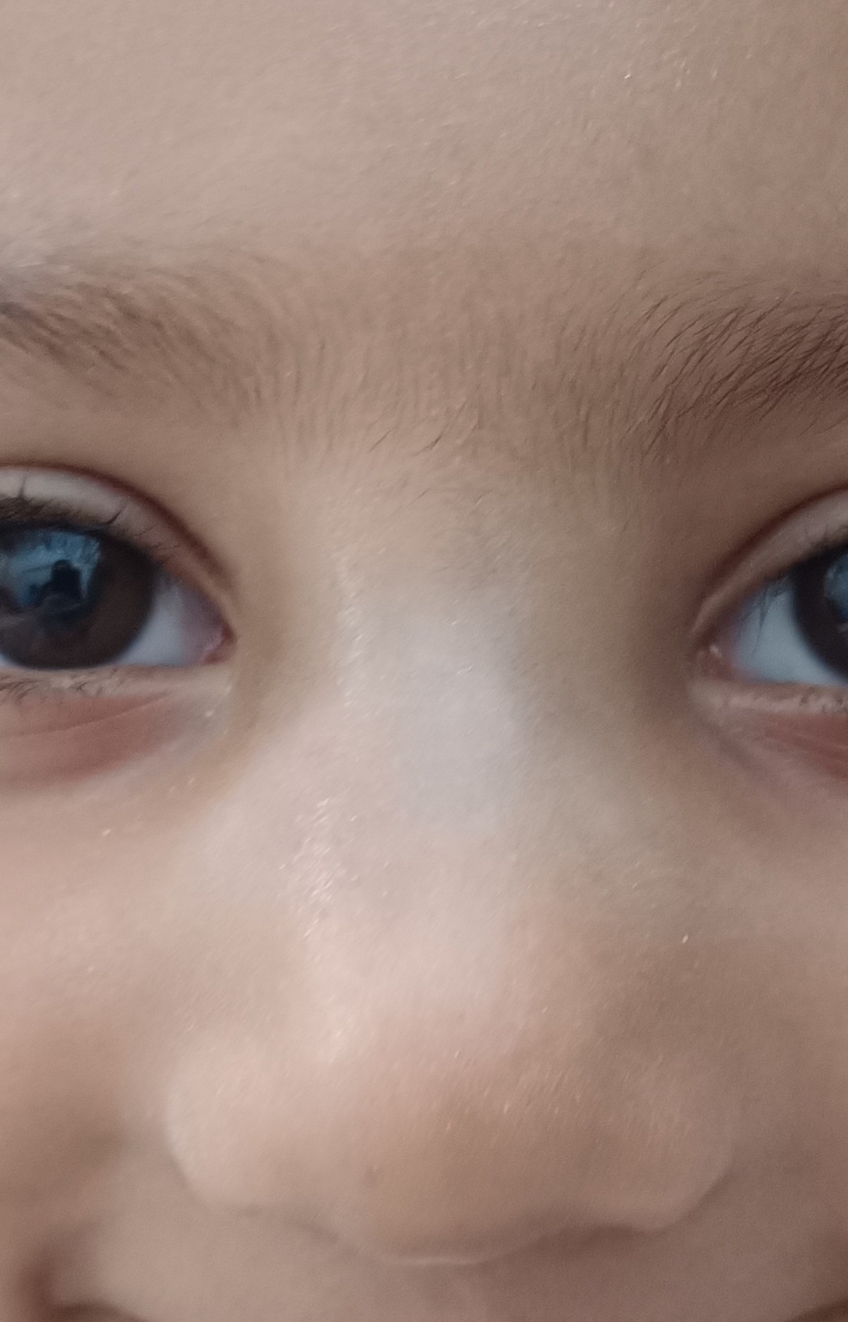 ضربه خوردن بینی کودک چهارساله
