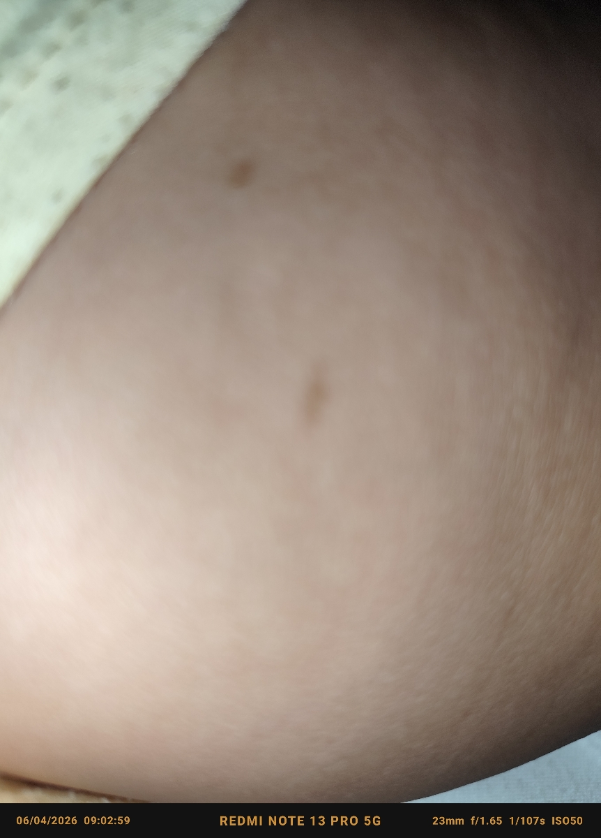 سلام خانم دکتر این خالها روی پوست بچم خال هست؟یا مشکل پوستی؟