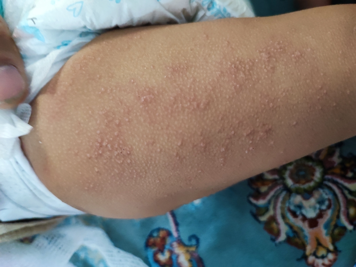 جوش های ریز روی پای کودک پانزده ماهه جوش های ریز روی پای کودک پانزده ماهه