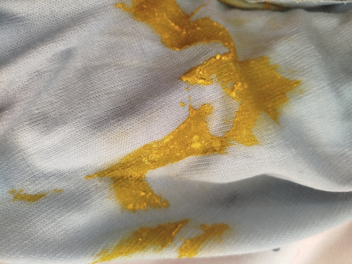 سوختگی پای نوزاد سوختگی پای نوزاد