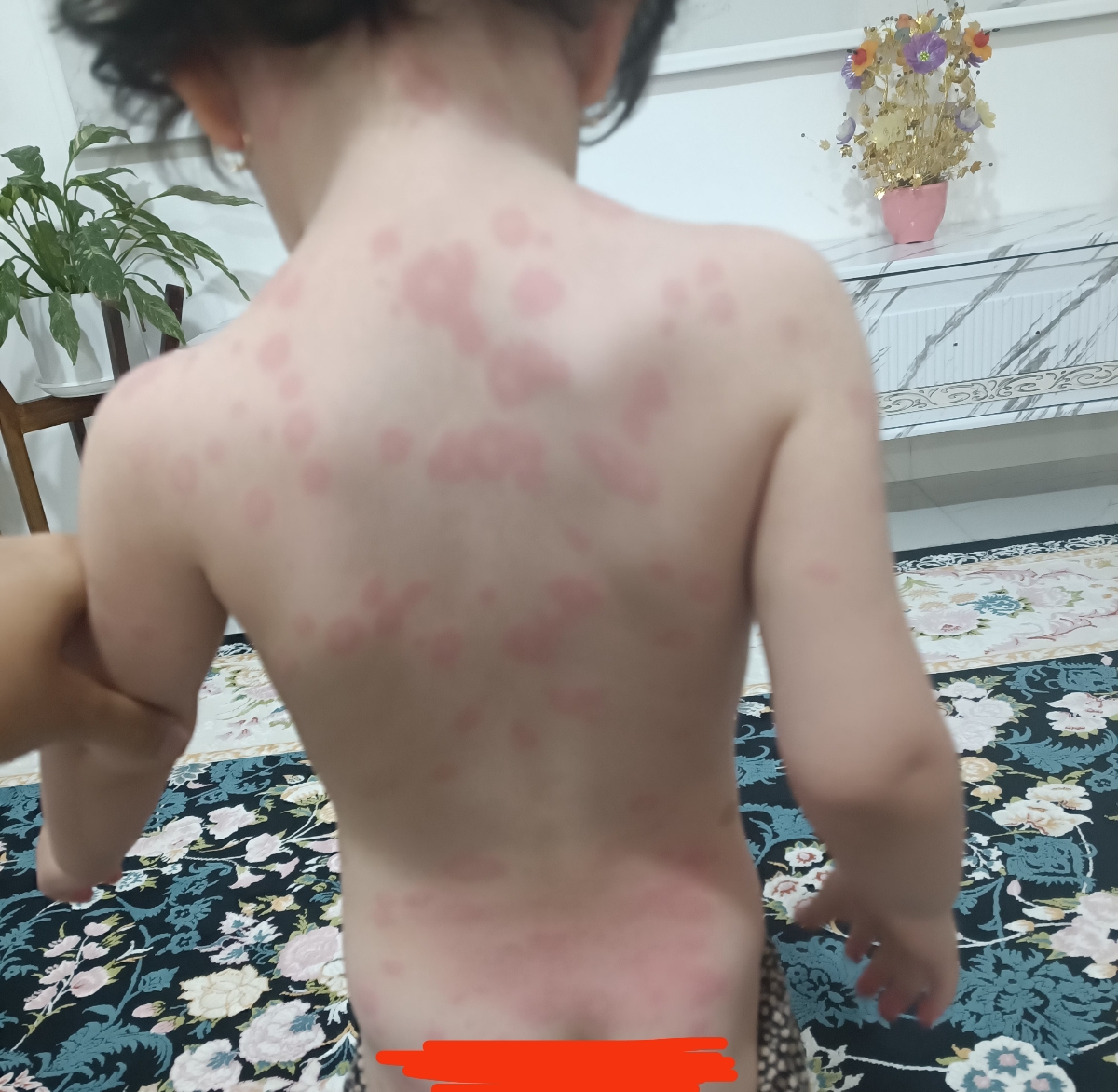 کهیر زدن وحشتناک صورت و بدن دخترم