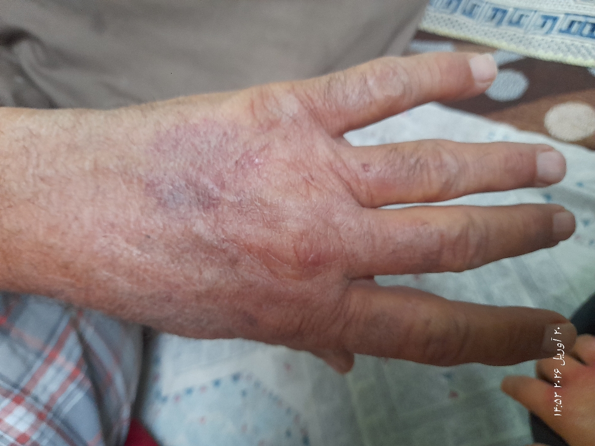 لکه های سیاه روی دست+عکس