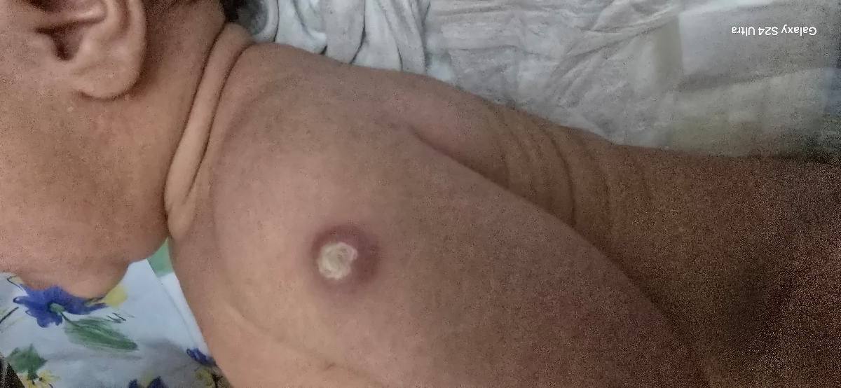 چرک کردن جای واکسن بدو تولد چرک کردن جای واکسن بدو تولد