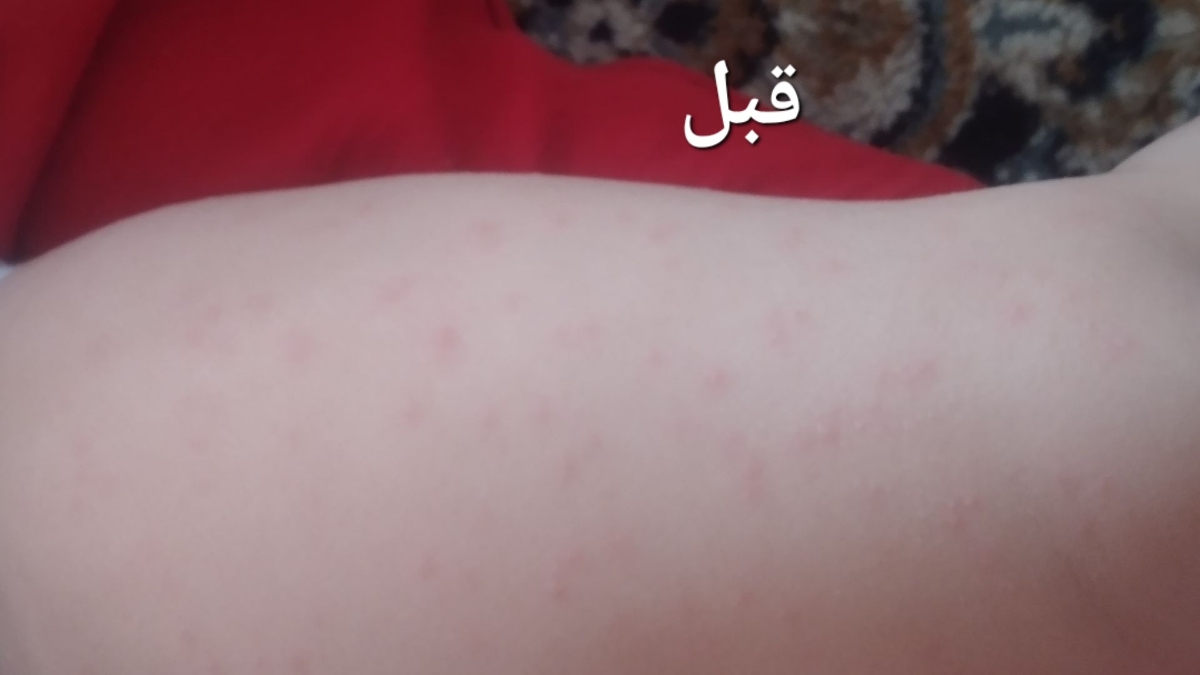 ❌❌اورژانسی. حساسیت پوستی کودک، عکس ❌❌