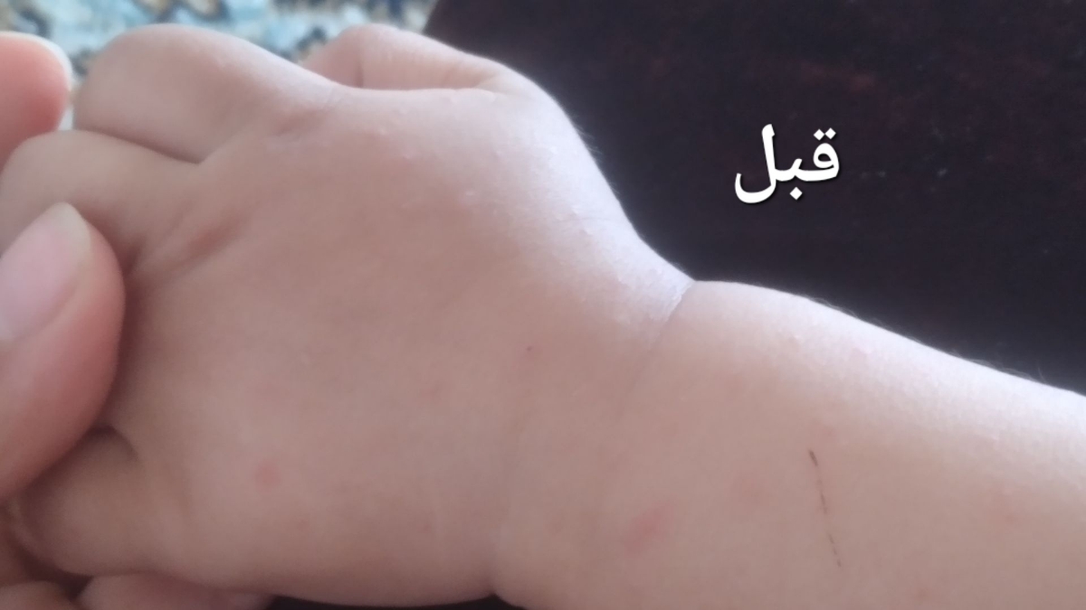 ❌❌اورژانسی. حساسیت پوستی کودک، عکس ❌❌