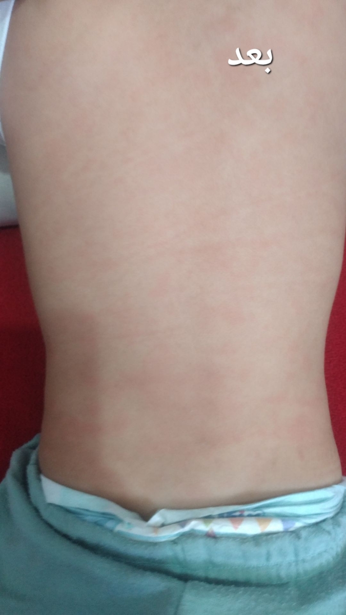 ❌❌اورژانسی. حساسیت پوستی کودک، عکس ❌❌