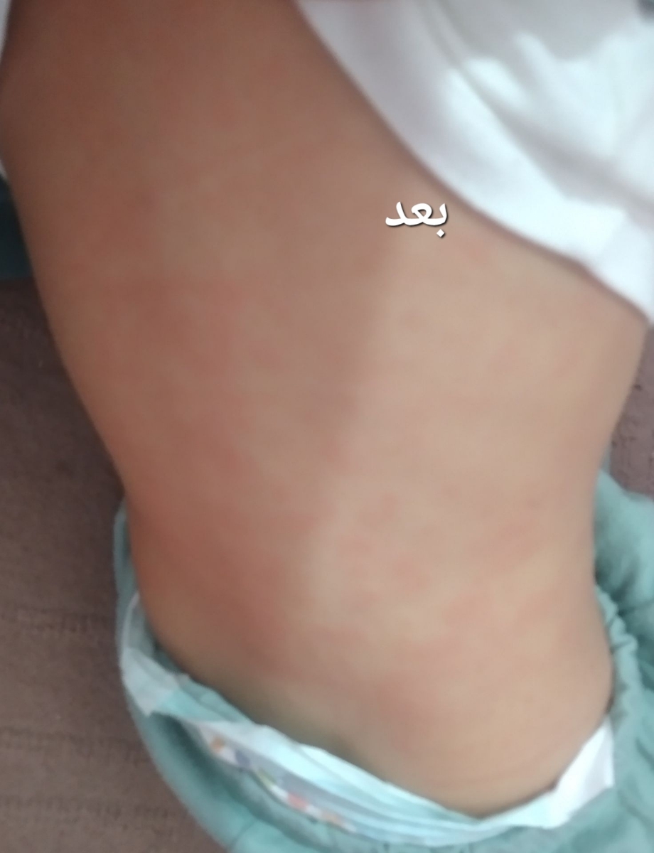 ❌❌اورژانسی. حساسیت پوستی کودک، عکس ❌❌